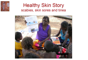 What is scabies, how do you get scabies, how do I know if I've got scabies, crusted scabies, what should I do, getting rid of scabies, what causes skin sores, what should I do, what is tinea, what should I do,