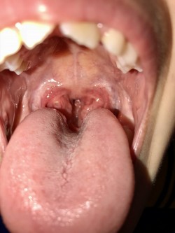 Strep A is only one cause of sore throat and tonsillitis, and is present in 10% to 40% of children with a sore throat.